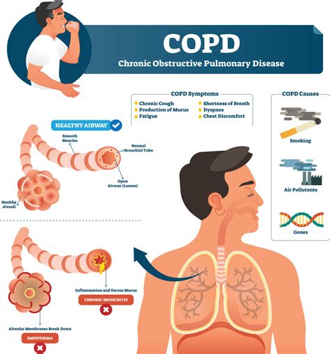 Chronic Obstructive Pulmonary Disease (COPD) Symptoms